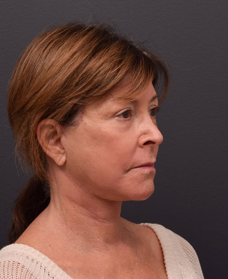 Facelift Before & After Gallery - Patient 354273 - Image 4