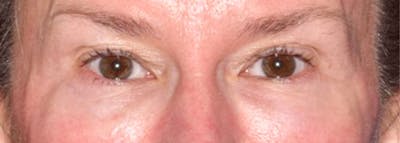 Upper Blepharoplasty Before & After Gallery - Patient 449135 - Image 1