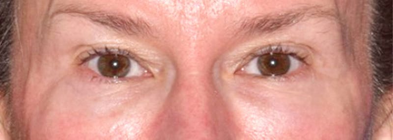 Upper Blepharoplasty Before & After Gallery - Patient 449135 - Image 1