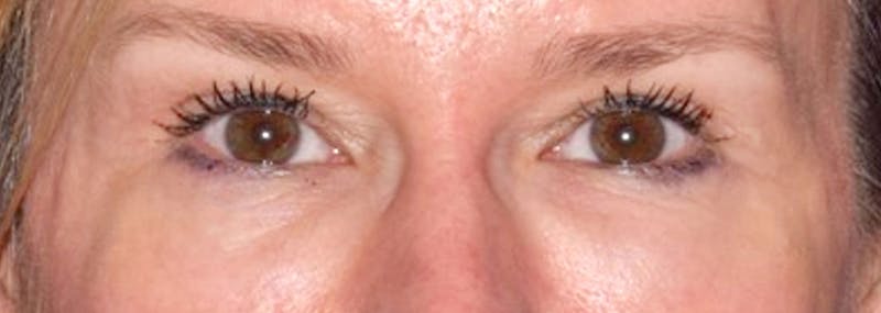Upper Blepharoplasty Before & After Gallery - Patient 449135 - Image 2