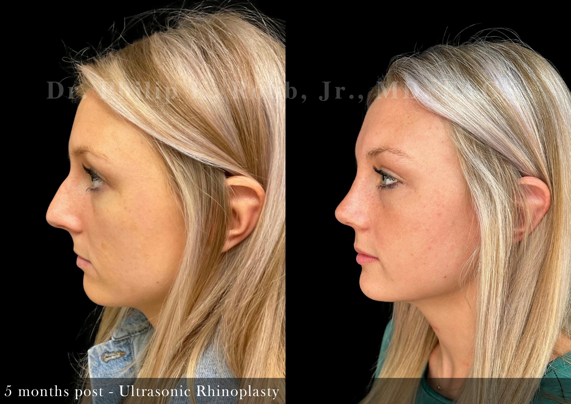 Ultrasonic Rhinoplasty Before & After Gallery - Patient 441686 - Image 5