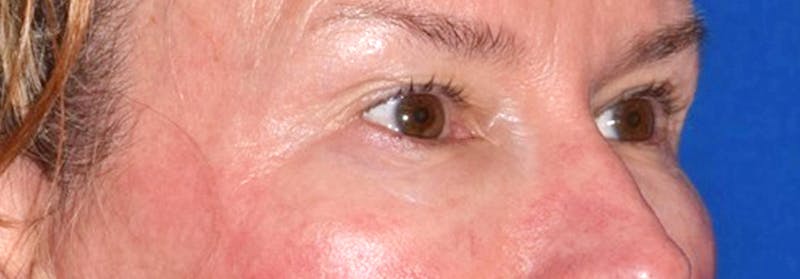 Upper Blepharoplasty Before & After Gallery - Patient 449135 - Image 3