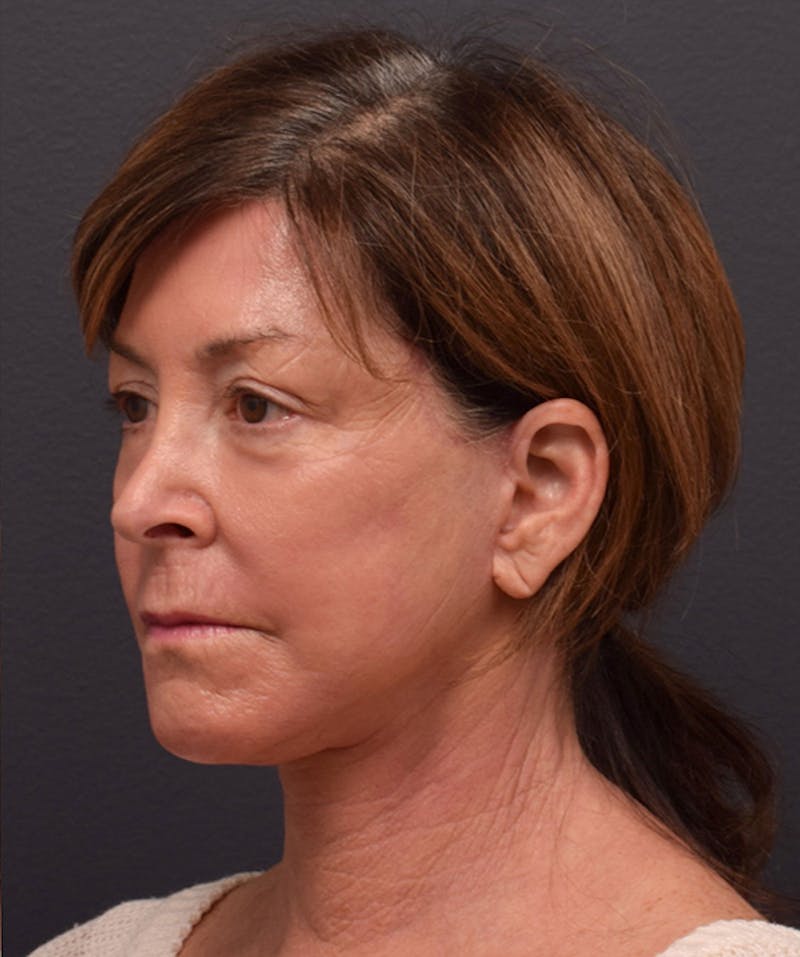Facelift Before & After Gallery - Patient 354273 - Image 8