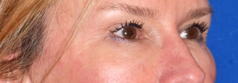 Upper Blepharoplasty Before & After Gallery - Patient 449135 - Image 4