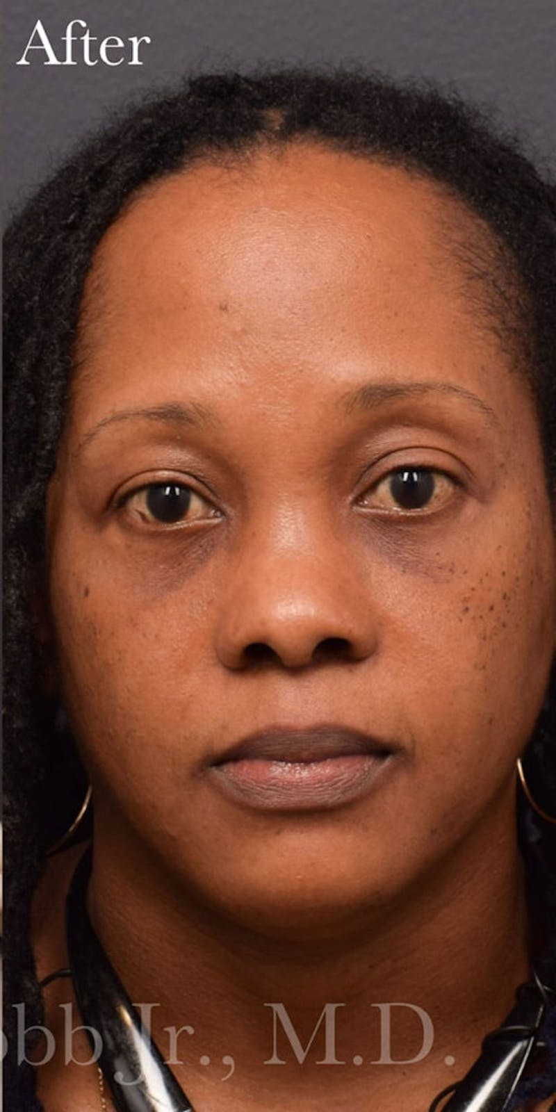 Lower Blepharoplasty Before & After Gallery - Patient 425800 - Image 2