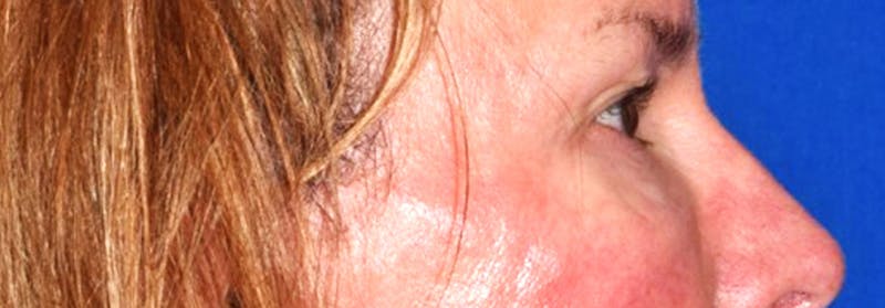 Upper Blepharoplasty Before & After Gallery - Patient 449135 - Image 5