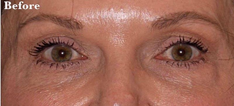 Laser Skin Resurfacing Before & After Gallery - Patient 287563 - Image 1