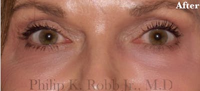 Laser Skin Resurfacing Before & After Gallery - Patient 287563 - Image 2