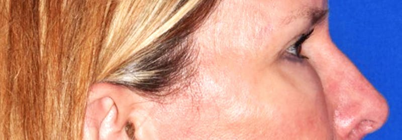 Upper Blepharoplasty Before & After Gallery - Patient 449135 - Image 6