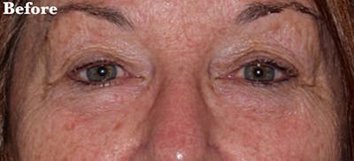 Laser Skin Resurfacing Before & After Gallery - Patient 407971 - Image 1