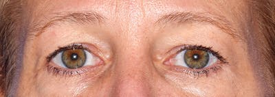 Upper Blepharoplasty Before & After Gallery - Patient 353782 - Image 1