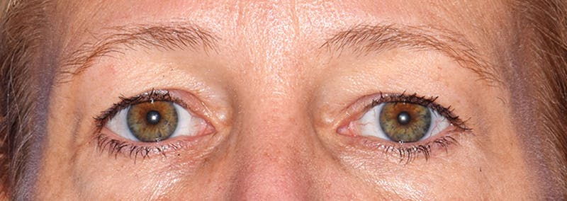 Upper Blepharoplasty Before & After Gallery - Patient 353782 - Image 1