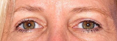 Upper Blepharoplasty Before & After Gallery - Patient 353782 - Image 2