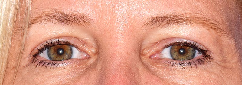 Upper Blepharoplasty Before & After Gallery - Patient 353782 - Image 2