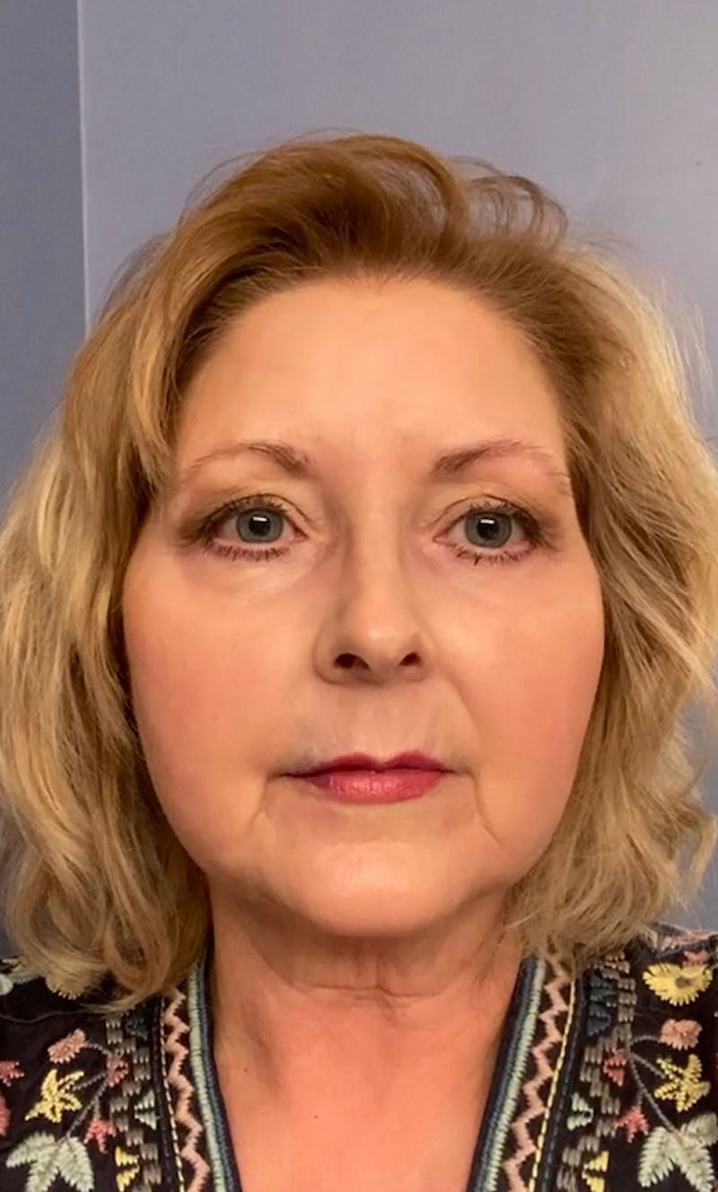 Lower Blepharoplasty Before & After Gallery - Patient 376652 - Image 2