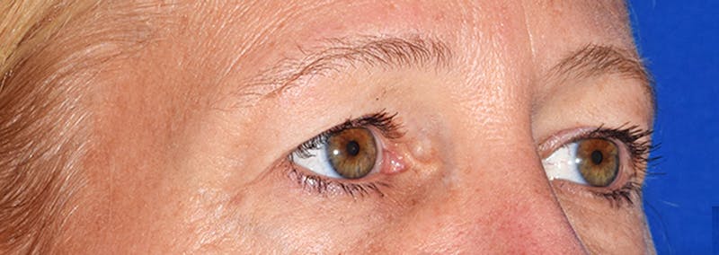 Upper Blepharoplasty Before & After Gallery - Patient 353782 - Image 3