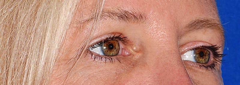 Upper Blepharoplasty Before & After Gallery - Patient 353782 - Image 4