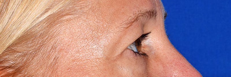Upper Blepharoplasty Before & After Gallery - Patient 353782 - Image 5