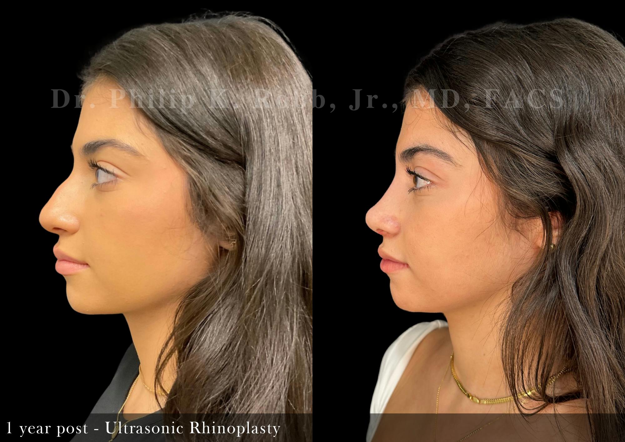 Ultrasonic Rhinoplasty Before & After Gallery - Patient 131995 - Image 5