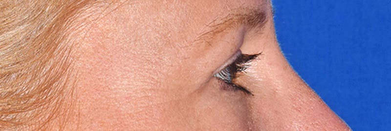 Upper Blepharoplasty Before & After Gallery - Patient 353782 - Image 6