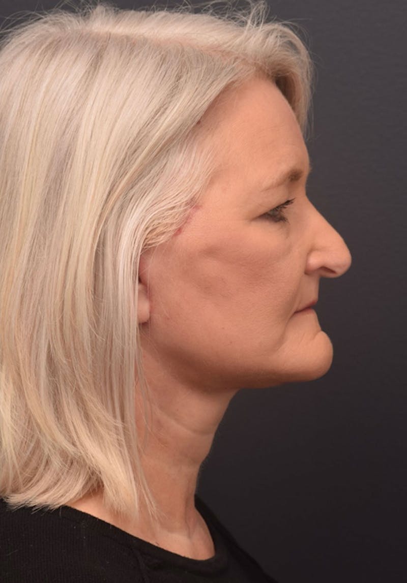 Facelift Before & After Gallery - Patient 194287 - Image 6