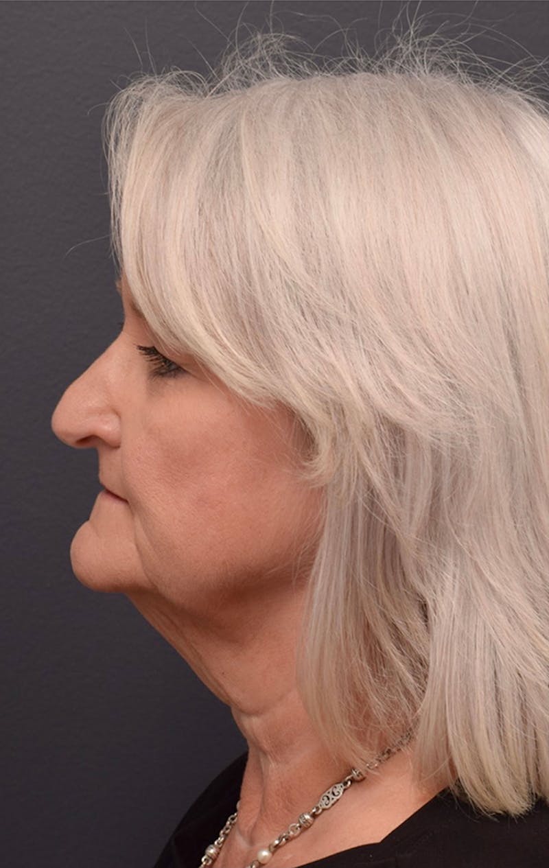 Facelift Before & After Gallery - Patient 194287 - Image 9