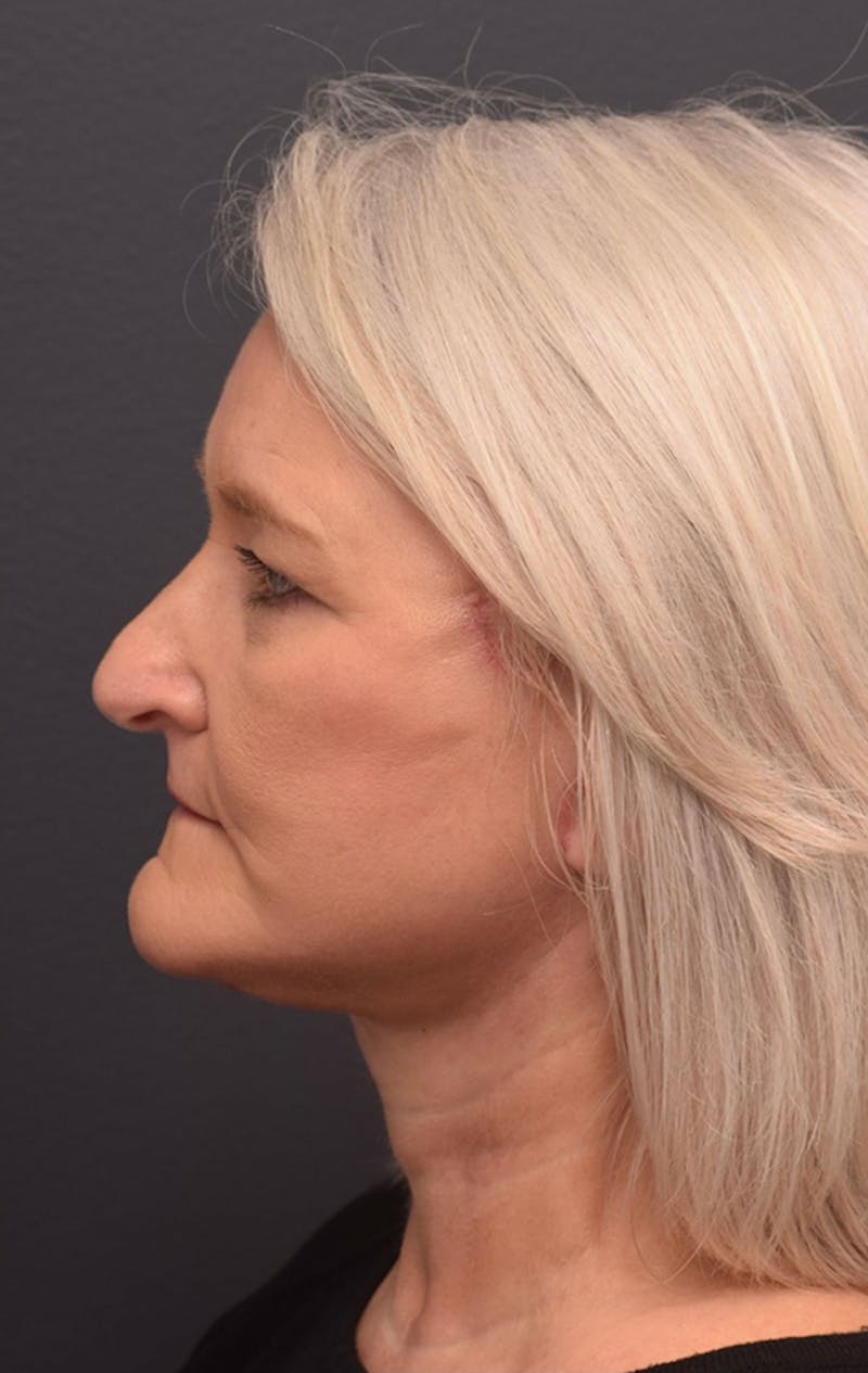 Facelift Before & After Gallery - Patient 194287 - Image 10