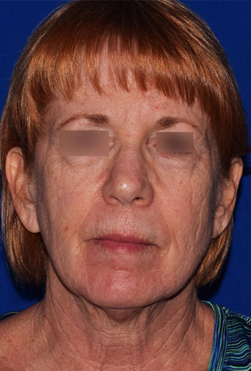 Facelift Before & After Gallery - Patient 129279 - Image 1