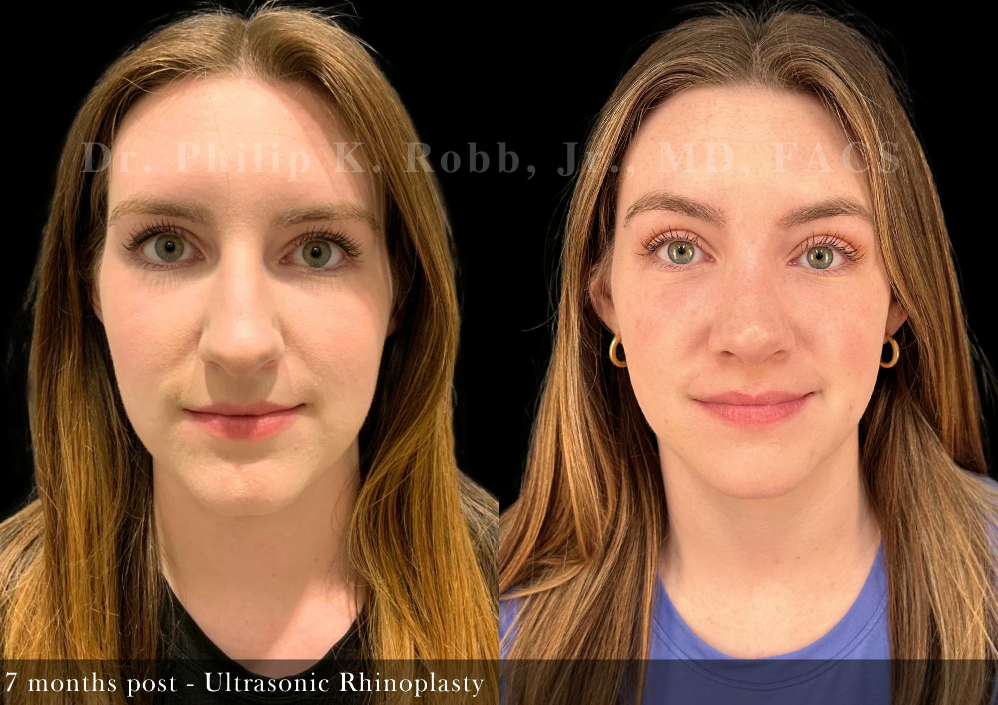 Ultrasonic Rhinoplasty Before & After Gallery - Patient 249110 - Image 3