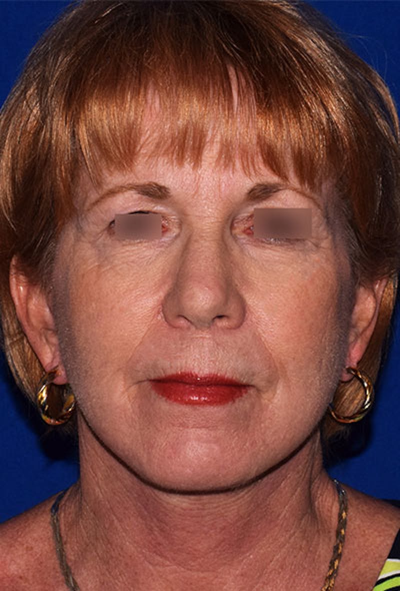 Facelift Before & After Gallery - Patient 129279 - Image 2