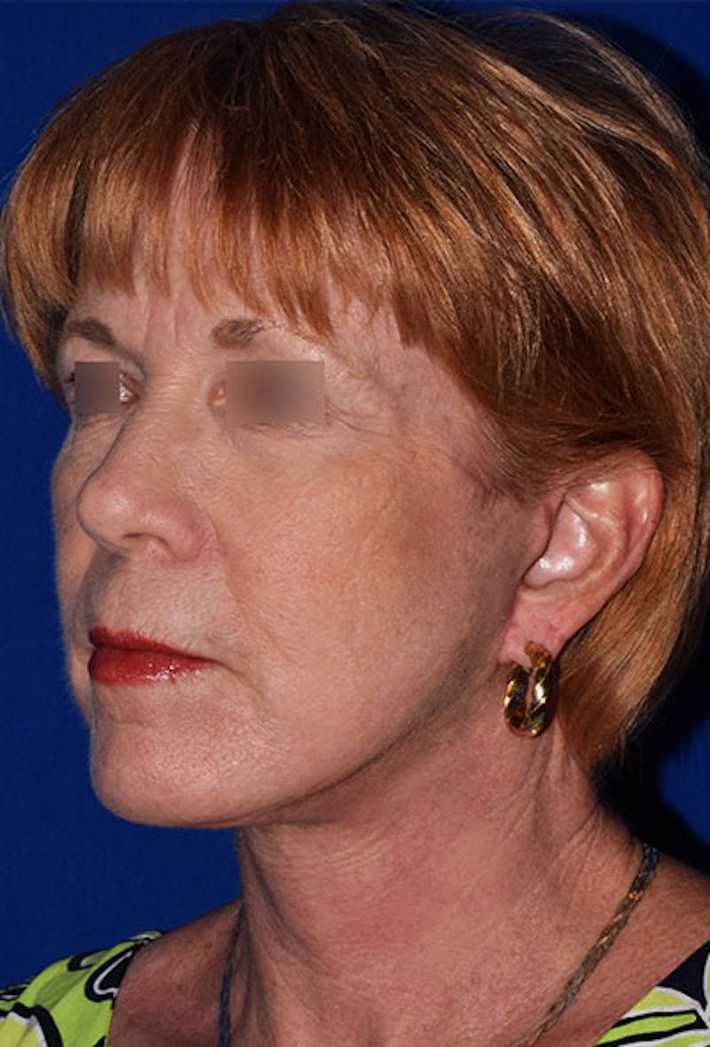 Facelift Before & After Gallery - Patient 129279 - Image 4