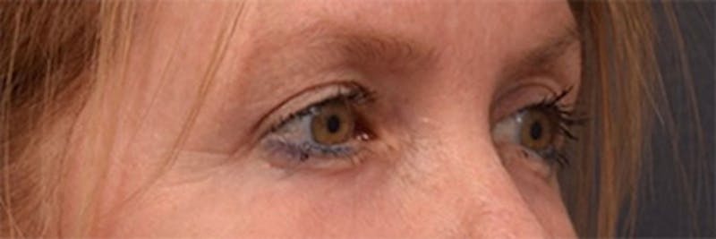 Laser Skin Resurfacing Before & After Gallery - Patient 360967 - Image 4