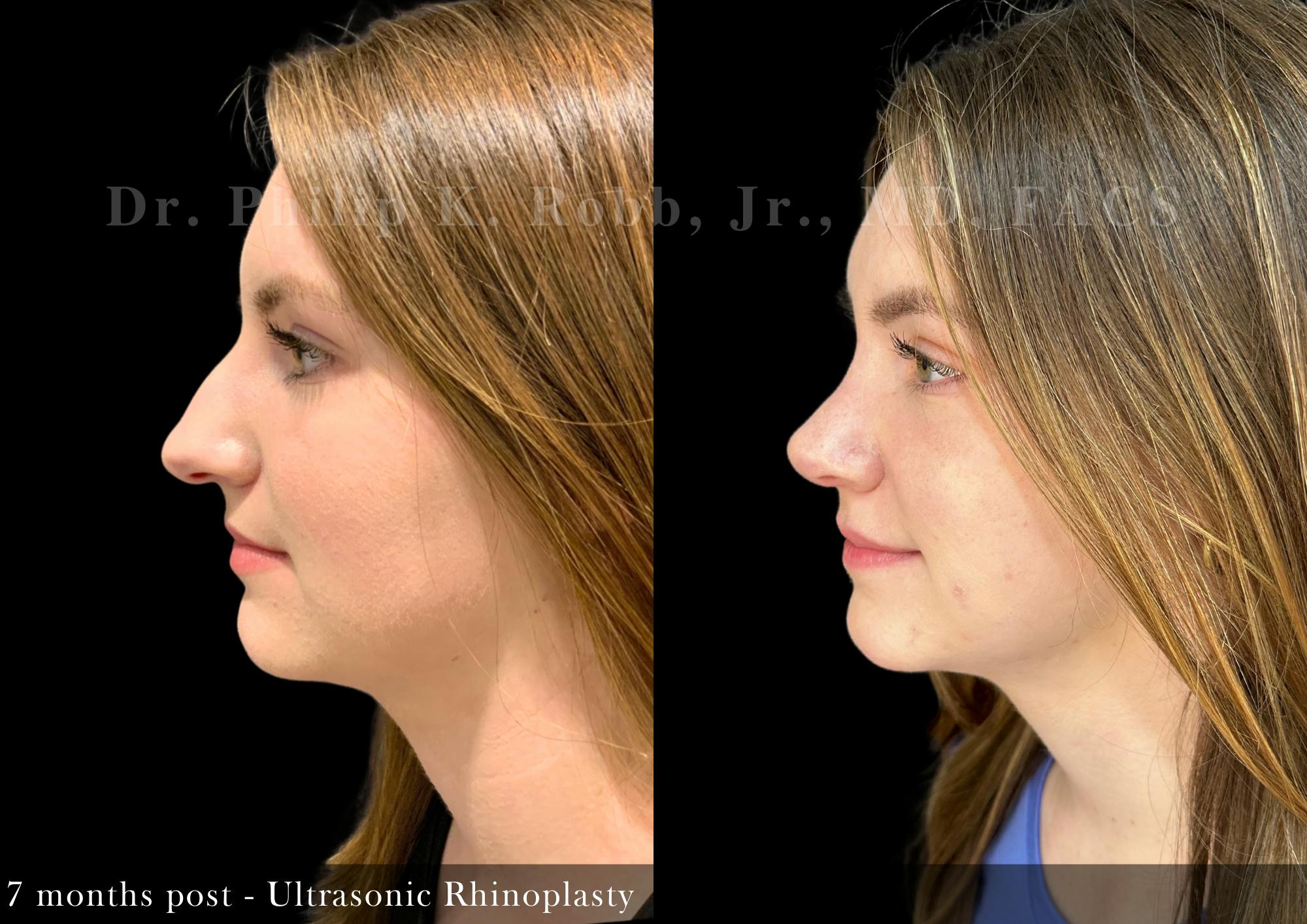 Ultrasonic Rhinoplasty Before & After Gallery - Patient 249110 - Image 5