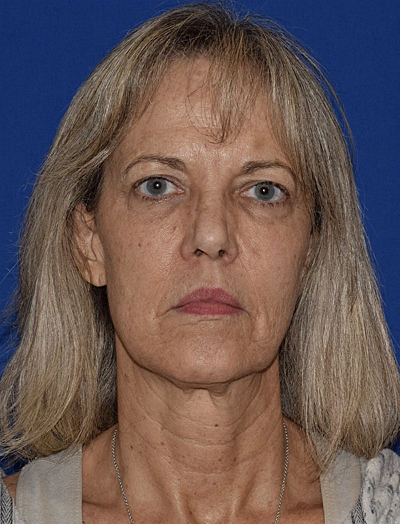 Facelift Before & After Gallery - Patient 420193 - Image 1