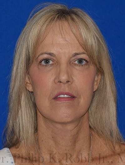 Facelift Before & After Gallery - Patient 420193 - Image 2