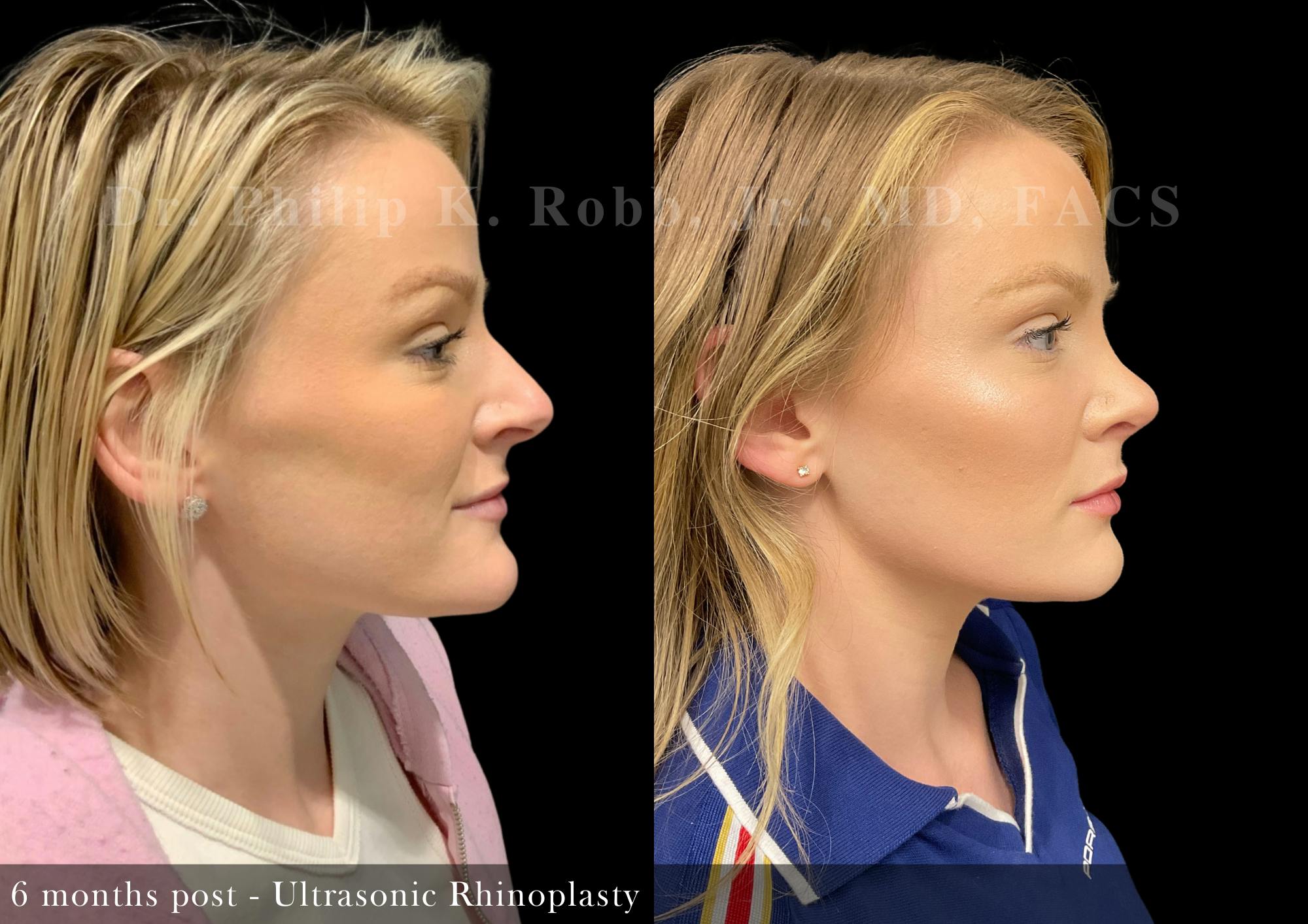 Ultrasonic Rhinoplasty Before & After Gallery - Patient 165184 - Image 1