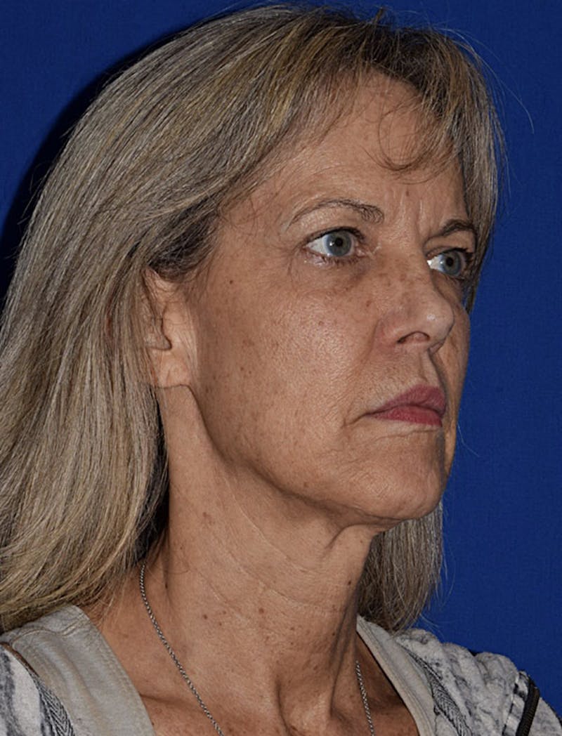 Facelift Before & After Gallery - Patient 420193 - Image 3