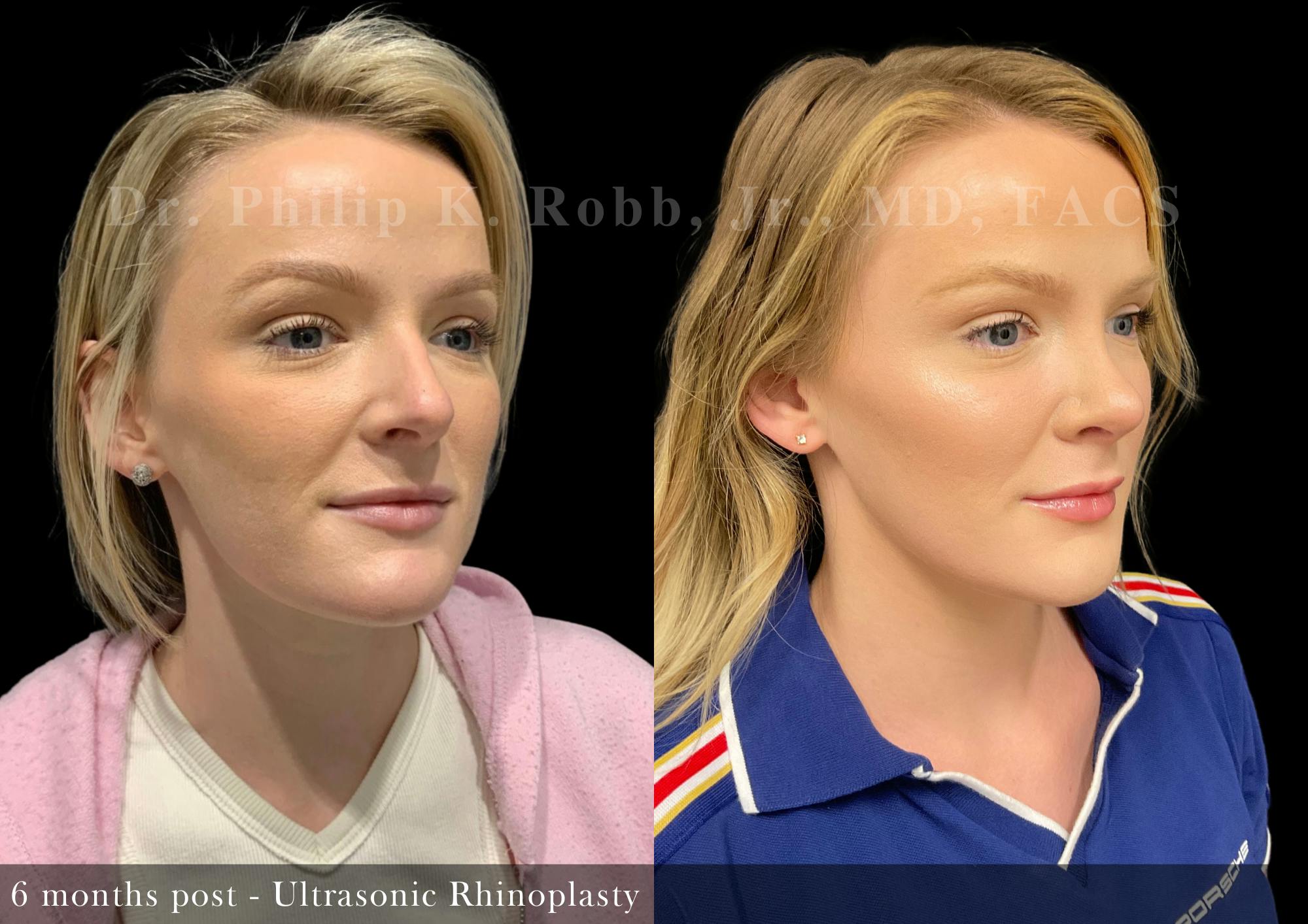 Ultrasonic Rhinoplasty Before & After Gallery - Patient 165184 - Image 2