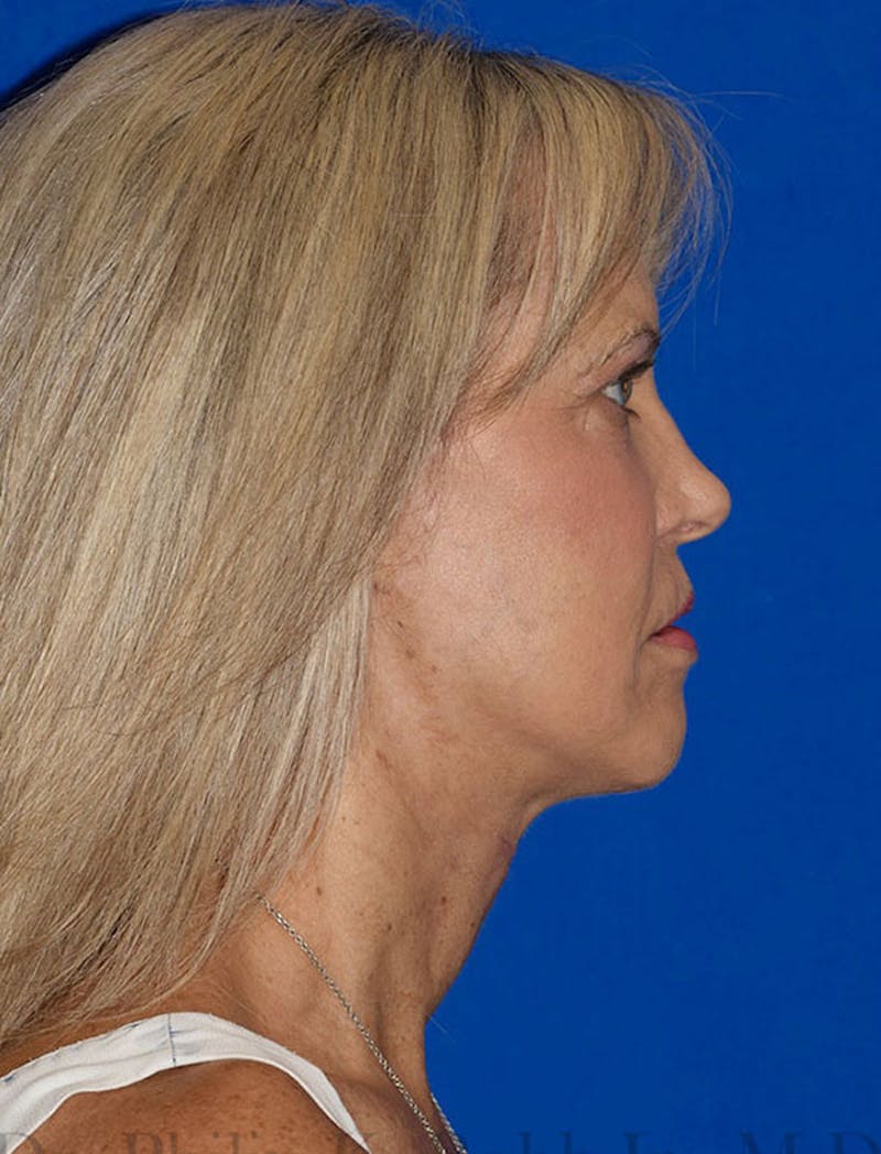 Facelift Before & After Gallery - Patient 420193 - Image 6