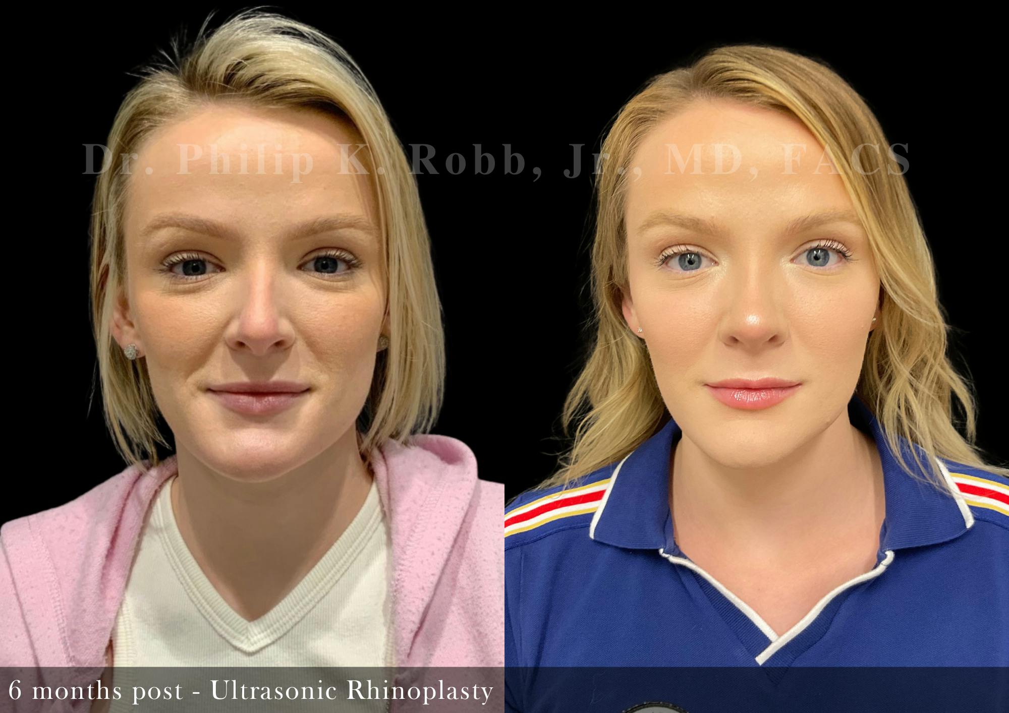 Ultrasonic Rhinoplasty Before & After Gallery - Patient 165184 - Image 3