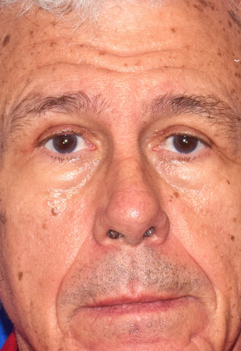 Upper Blepharoplasty Before & After Gallery - Patient 184503 - Image 2