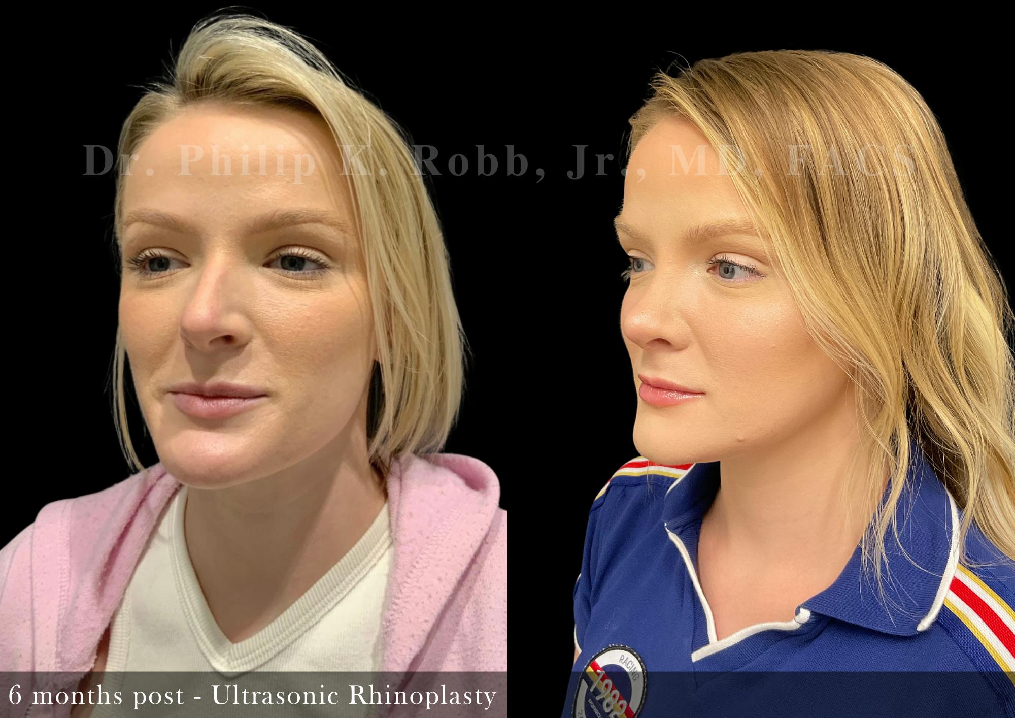 Ultrasonic Rhinoplasty Before & After Gallery - Patient 165184 - Image 4