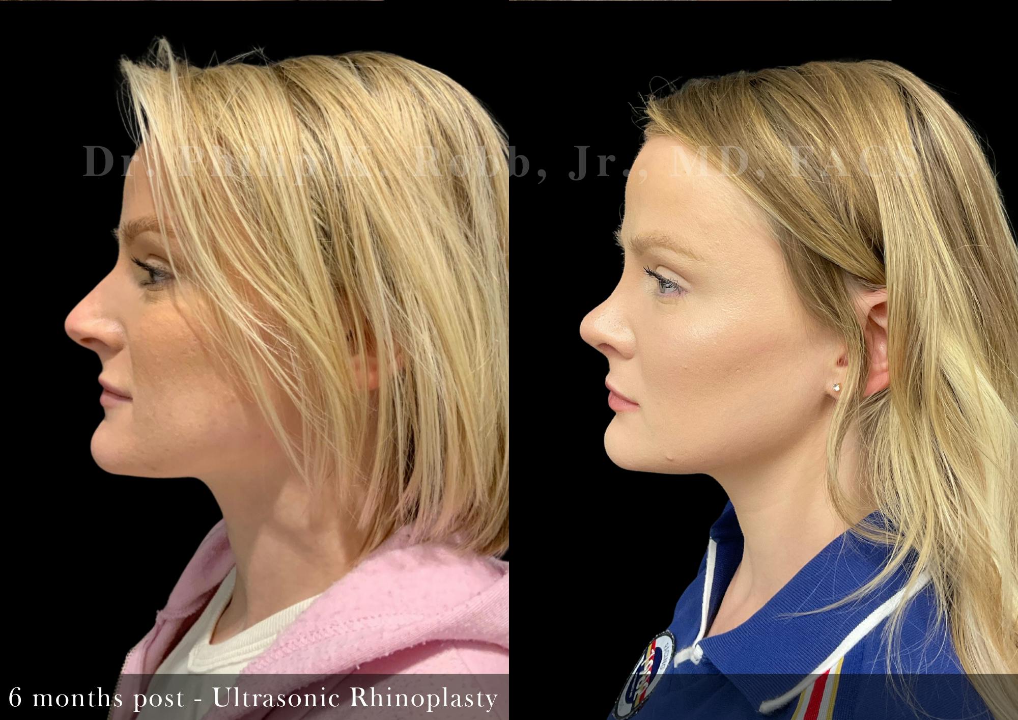 Ultrasonic Rhinoplasty Before & After Gallery - Patient 165184 - Image 5