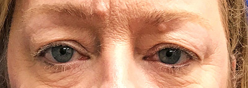 Upper Blepharoplasty Before & After Gallery - Patient 401527 - Image 1