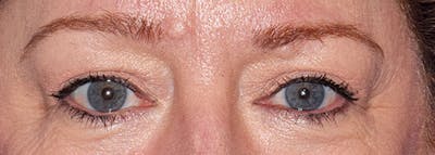 Upper Blepharoplasty Before & After Gallery - Patient 401527 - Image 2