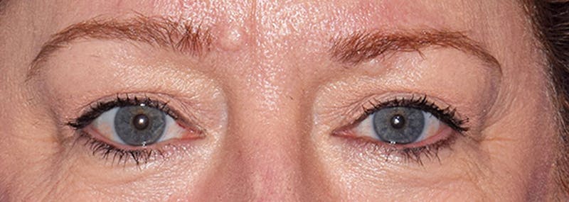 Upper Blepharoplasty Before & After Gallery - Patient 401527 - Image 2