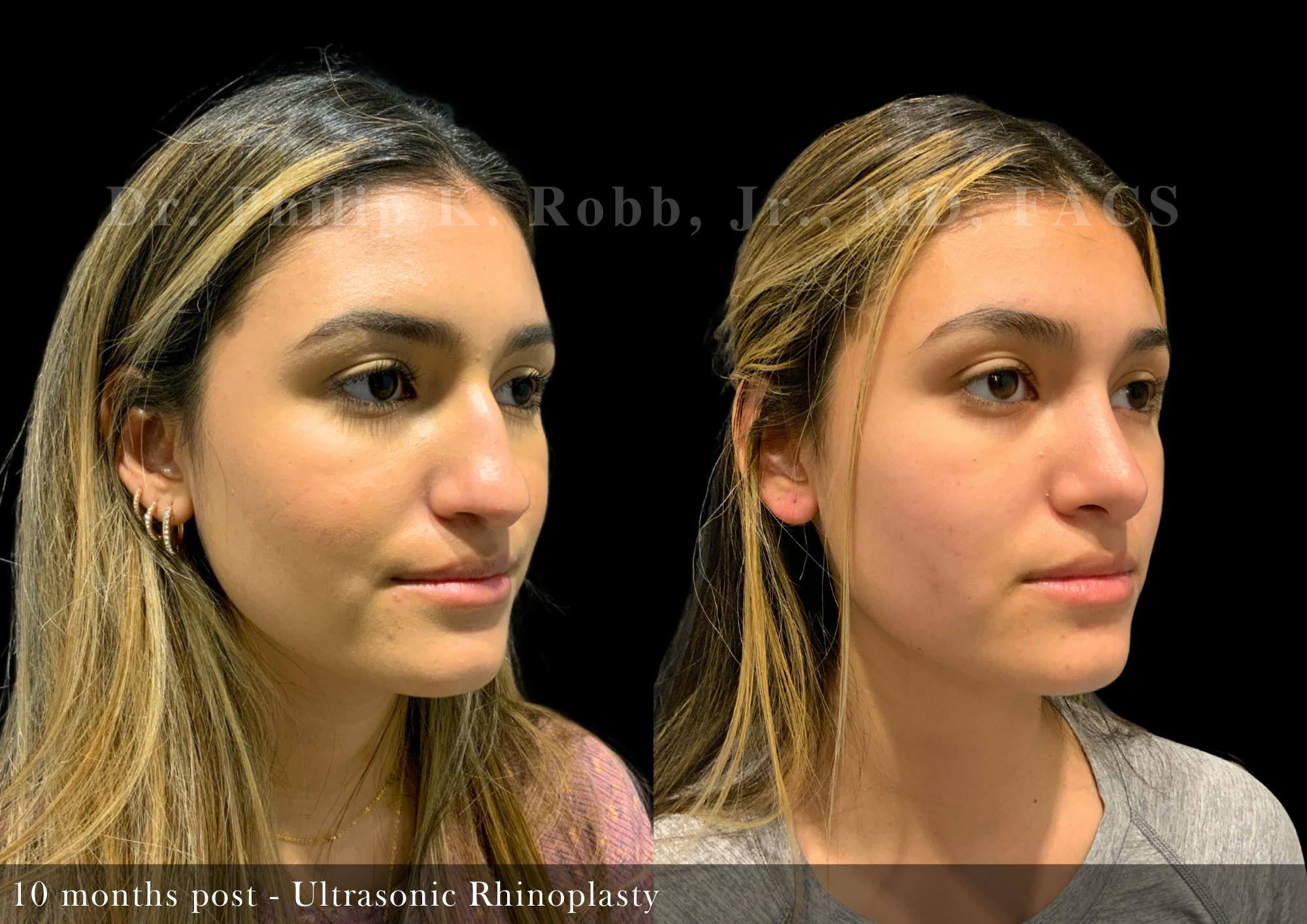 Ultrasonic Rhinoplasty Before & After Gallery - Patient 277055 - Image 2