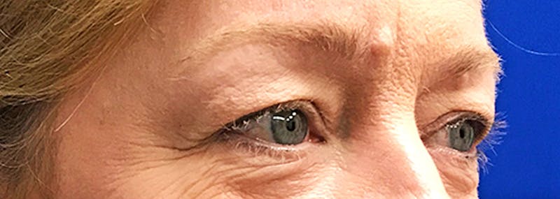 Upper Blepharoplasty Before & After Gallery - Patient 401527 - Image 3