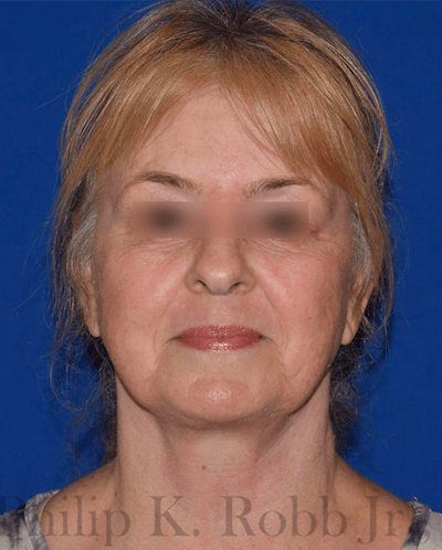 Facelift Before & After Gallery - Patient 154116 - Image 2