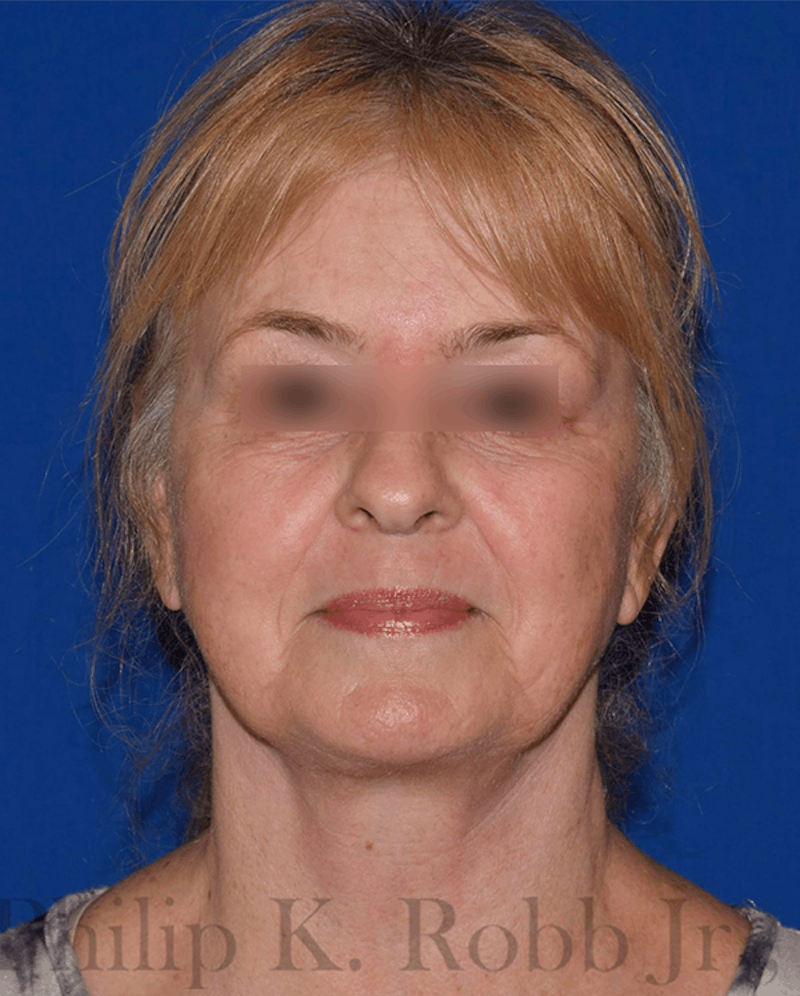 Facelift Before & After Gallery - Patient 154116 - Image 2